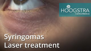 Syringomas - Laser treatment (21024)