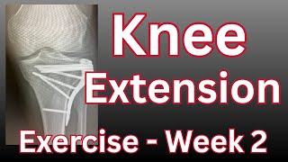 Tibial Plateau Fracture - Best Knee Extension Exercise EVER