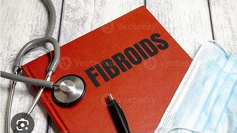 My ppt on Fibroid presented at CME