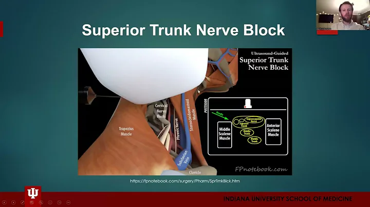 Superior Trunk Nerve Block by Blake Brookshire, MD...