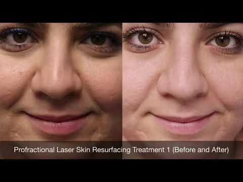 Acne Scar Removal Results