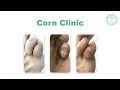 Dubai Podiatry Centre - Corn Clinic