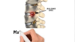 Car accident caused disc problem | Acworth | Kennesaw