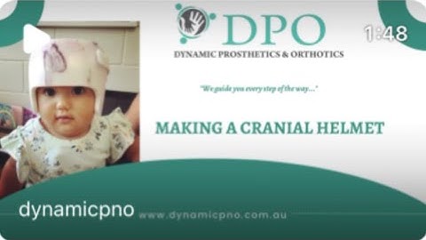 How a Cranial Helmet is made