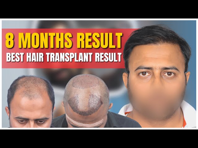 HAIR TRANSPLANT FOR PERMANENT HAIR RESTORATION IN VADODARA RichFeel Hair  Clinic Vadodara is a reputed hair transplant clinic which encourages its  visitors to find out more about the hair restoration procedure and