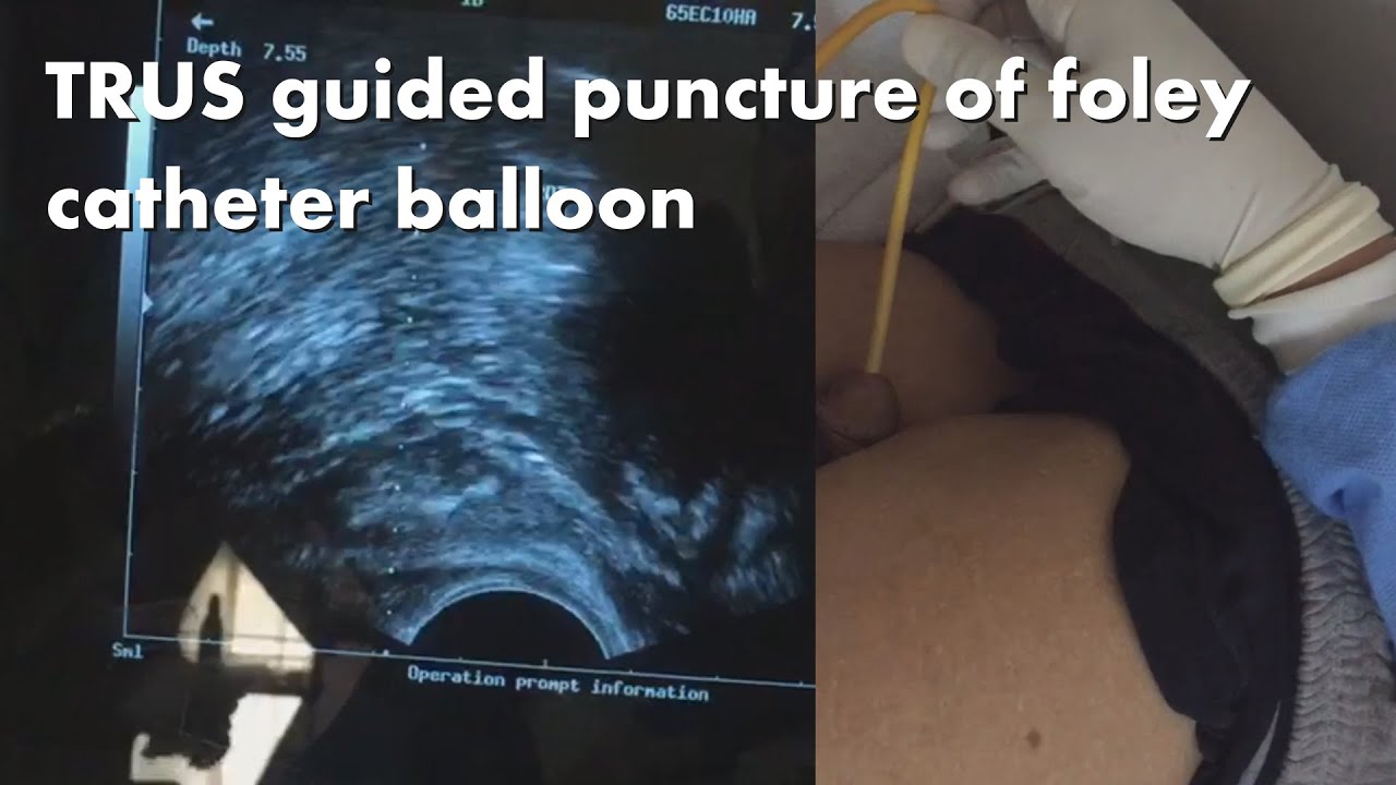 Transrectal ultrasound (TRUS) guided puncture to release retained foley
