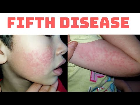Fifth Disease | Erythema Infectiosum 
