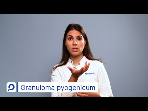 Video: Wie entferne ich ein pyogenes Granulom zu Hause?