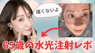 【水光注射】【ジャルプロ】👵65歳で肌育は可能❓💉注入系何がイイ❓当日〜2週間までのレポ動画🤳