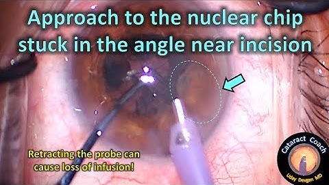 How to safely remove a nuclear piece near the incision in Cataract Surgery