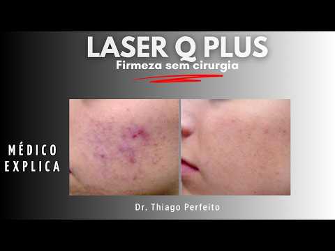 Laser Q-Plus: como trata manchas, melasma e tatuagem — vídeo do Dr. Thiago Perfeito
