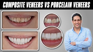 Composite Veneers (Bonding) VS Porcelain Veneers | Which is Better? | Best Dentist in Pakistan