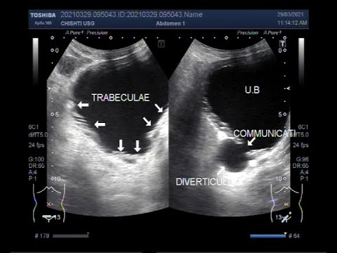 Trabeculation of the Urinary bladder with a Diverticulum.