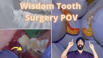 Step by Step Distoangular Impacted Wisdom Tooth Surgical Extraction CURVED ROOTS