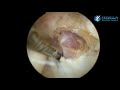 Tennis Elbow Surgery Arthroscopy Frisella Shoulder Surgery