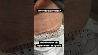 2 Year Follow Up Doing Great Bikini Incision Direct Anterior Hip Replacements | Dr. Robert Cagle