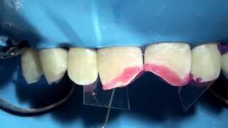 Estelite Sigma Quick İle Kırık Restorasyonu