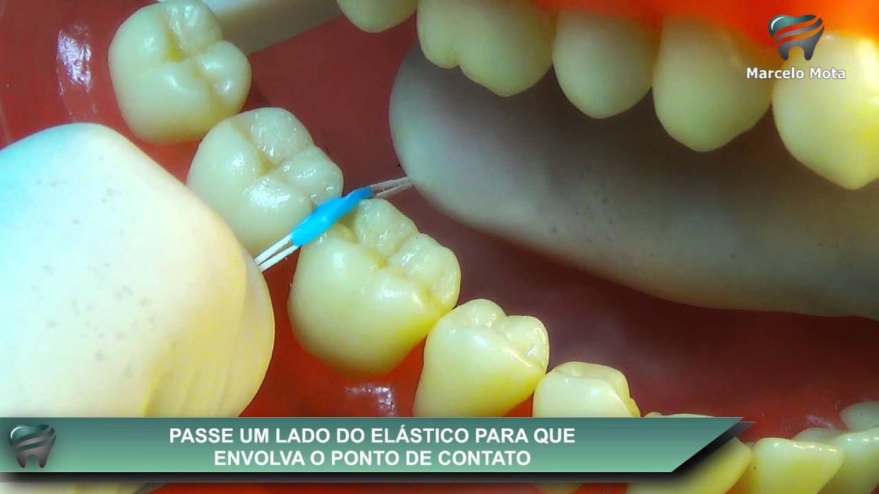 SEPARADORES ELÁSTICOS para ANÉIS ORTODÔNTICAS