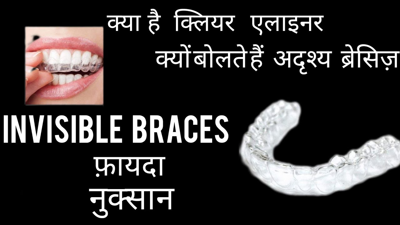 Invisible braces kya hai clear aligners orthodontist. clearaligner