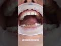 Let see Zirconia Crown