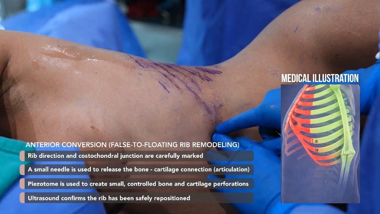 Rib Remodeling Surgery: Anterior False-to-Floating Rib Conversion ...