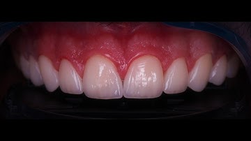 Ivoclar Vivadent , E-max Ceram Micro Layering , IPS.E-max CAD MT A1 , E-max Ceram Building