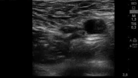 femoral