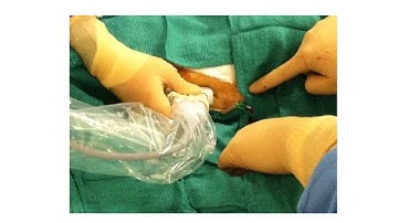 Retrograde CTO Crossing for Patient with Severe PAD