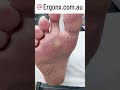 Podiatrist's Guide to Corn & Callus Removal #FootCare #Podiatry