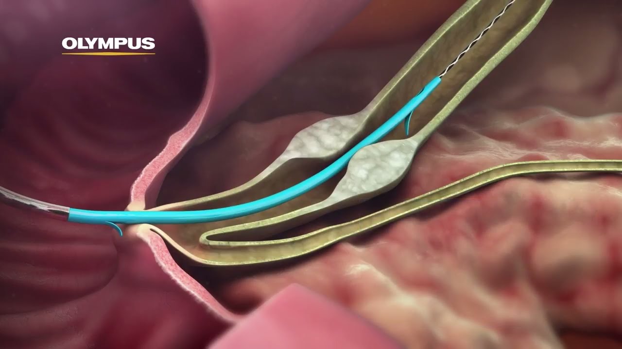 ercp stent