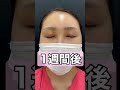 眉下&目頭切開をしてアーモンドアイ整形をしました。
