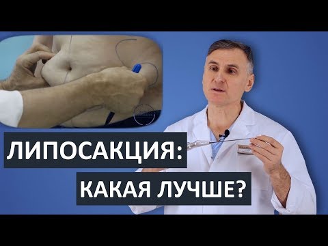 ?ЛИПОСАКЦИЯ: КЛАСИЧЕСКАЯ, УЛЬТРАЗВУКОВАЯ, ЛАЗЕРНАЯ, ВОДНАЯ. ЧТО ЛУЧШЕ?