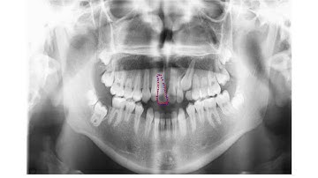 ASM: Fitting a Model