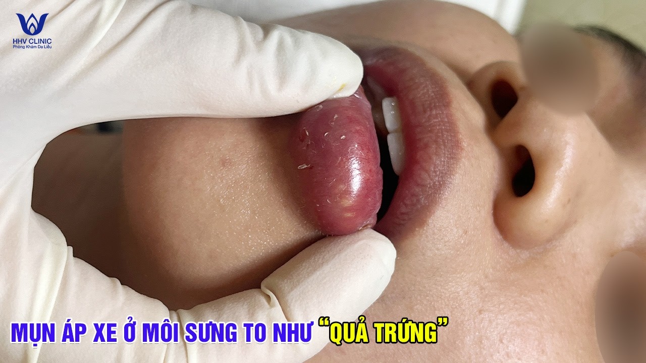 Ca Mụn Áp Xe Môi Dưới Viêm Nặng Xử Lý Chuẩn Y Khoa.