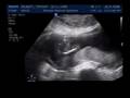 Destry jamison stalsworth  21 week ultra sound