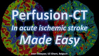 Perfusion CT made easy - everything you always wanted to know about PCT in acute ischemic stroke.