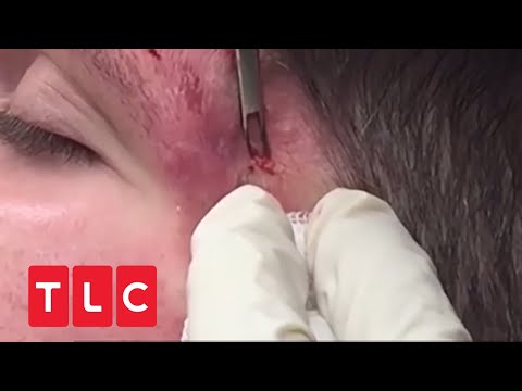 Video: Eine Zyste im Gesicht entfernen – wikiHow