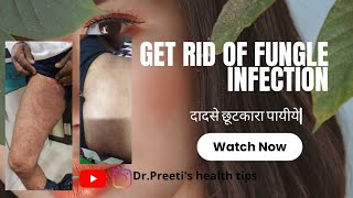 Get cured of fungle infection..दाद से छूटकारा पायीये| Part 1