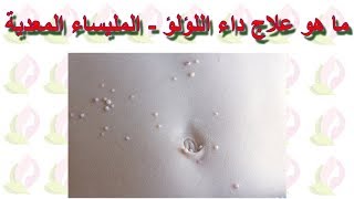 ما علاج داء اللؤلؤ أو المليساء المعدية Molluscum contagiosum