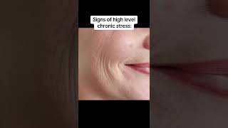 Chronic stress affects skin (acne, eczema, dryness) and overall health (anxiety, fatigue, headaches