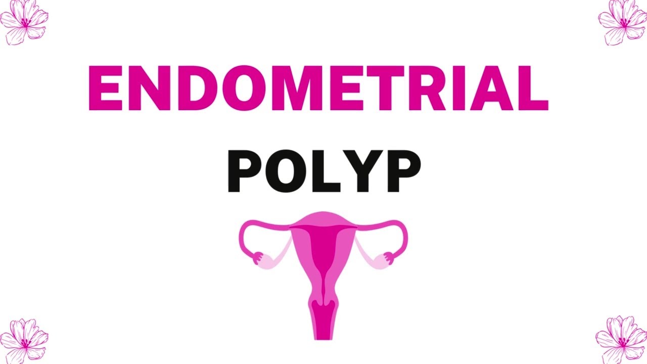 Endometrial Polyp | Definition,C/F,Pathophysiology,Investigations ...
