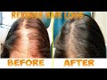 How I STOPPED MY HAIR LOSS! №1 Thing That Re Grew My Hair! #hair