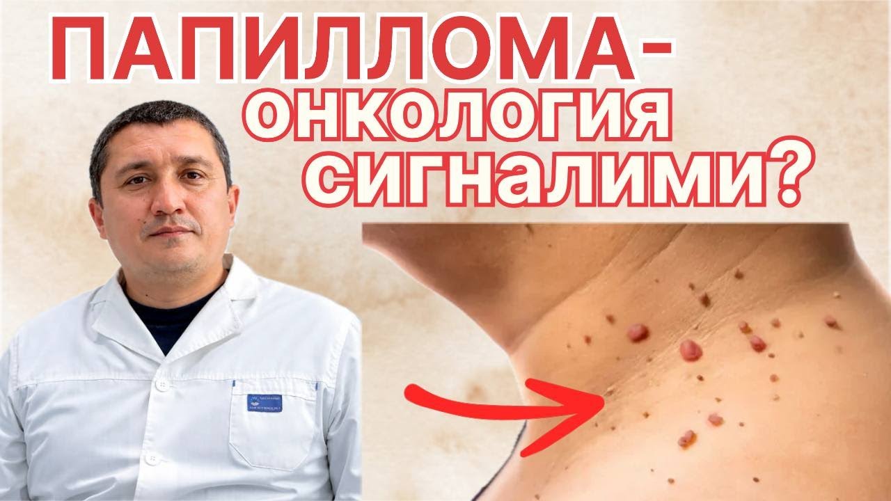 Папиллома ва HPV вируси: нималарни билиш керак? 