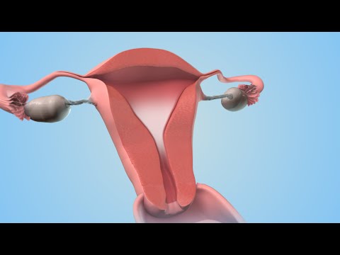 Video: Kaip naudoti gimdos kaklelio dangtelį