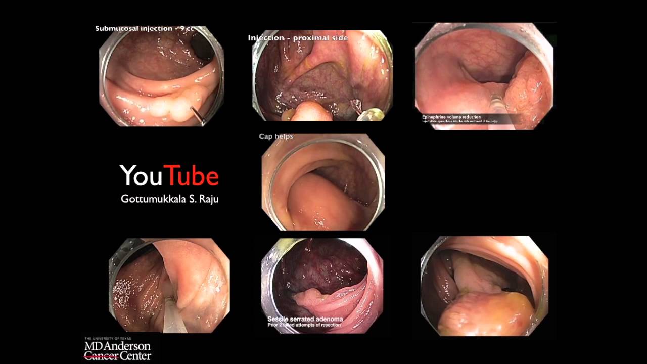 Colonoscopy:Colonoscopy: Complex Colon Polypectomy - Mississippi GI