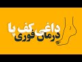علت داغی کف پا و روش های خانگی درمان آن