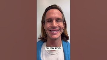 #shorts Daxxify vs Botox Split Face Trial 3 Month Follow up