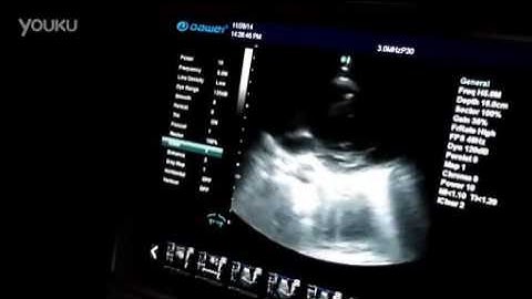 Demo video of DW C60plus with phased array probe