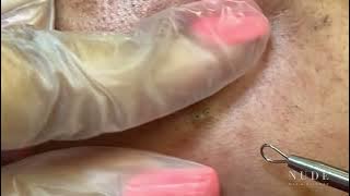 Extractions From Nude Ep.10 ! That’s a lot of blackheads! ASMR ?