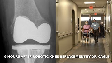 6 Hours After Outpatient MAKO (Robotic) Knee Replacement Doing Great | Dr. Robert Cagle